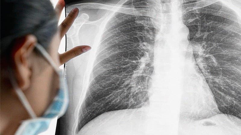 dấu hiệu bệnh phổi trắng ở người lớn