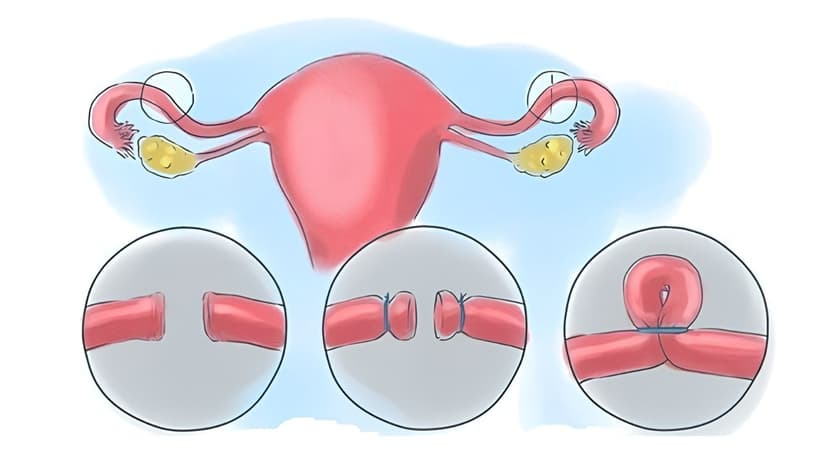 Phụ nữ có nên triệt sản không? Có tác dụng phụ nào không?