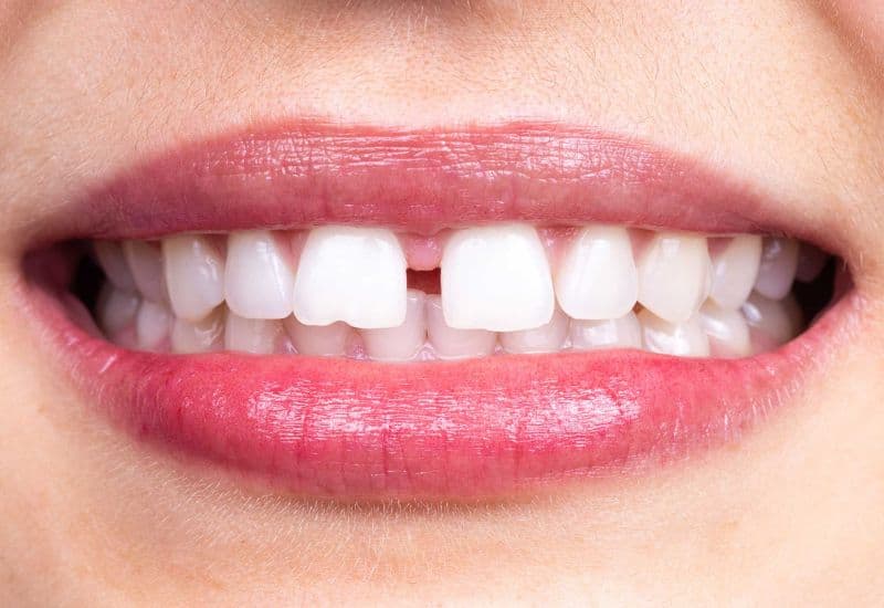 quá trình đóng khoảng răng