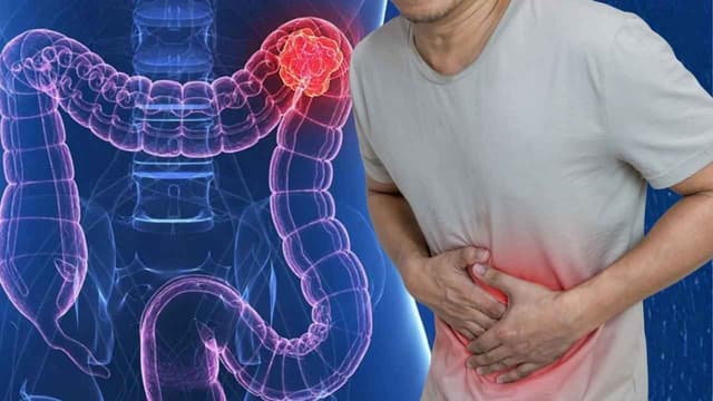 Quy trình tầm soát ung thư đại tràng