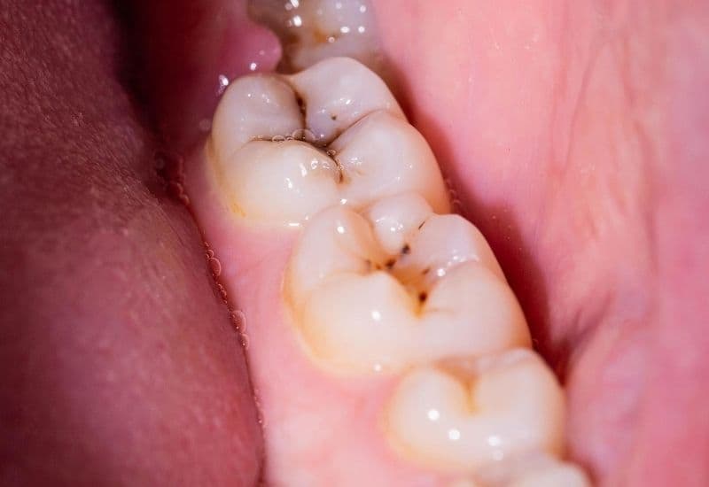 răng sâu độ 2 là như thế nào