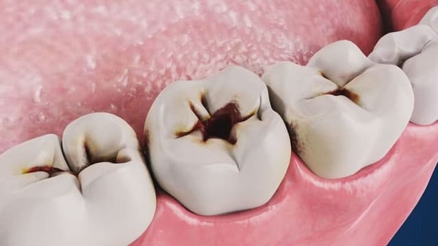 Răng sâu độ 2 là như thế nào?