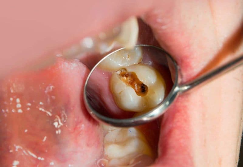 răng sâu độ 4 là như thế nào