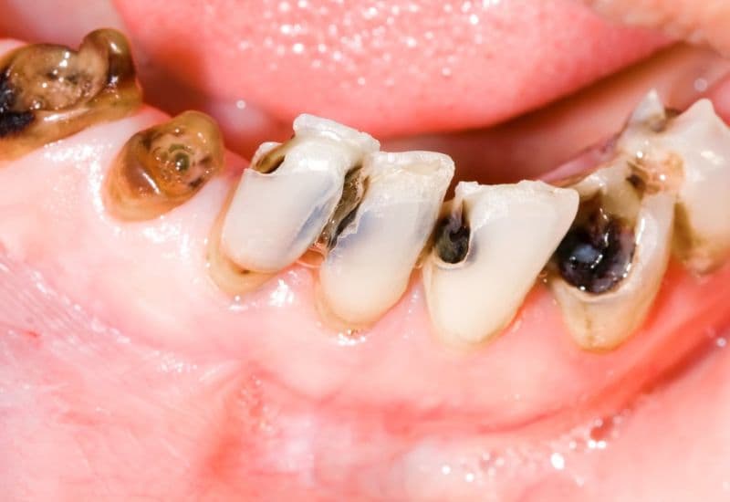 răng sâu nặng có niềng được không