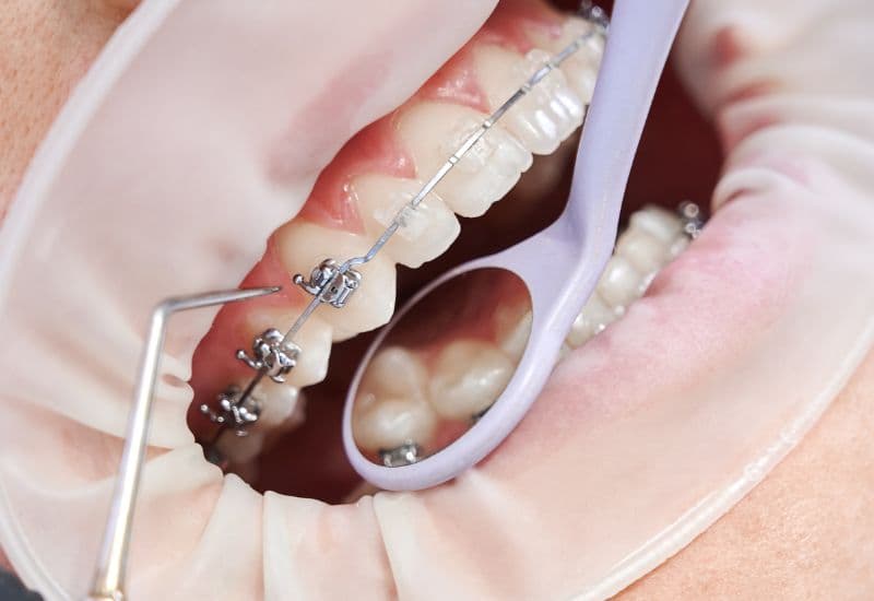 răng sâu nặng có niềng được không