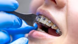 Răng sâu nặng có niềng được không?