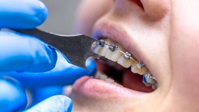 Răng sâu nặng có niềng được không?