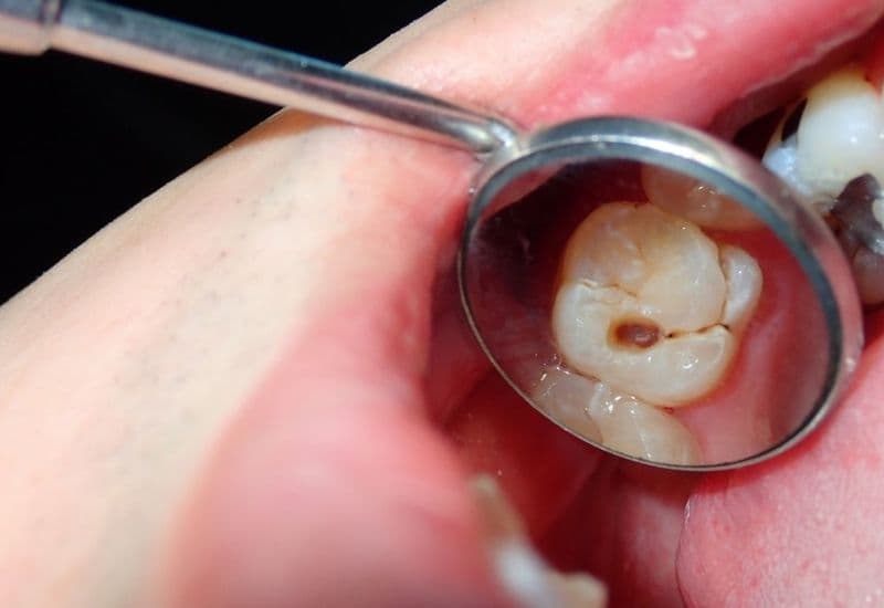 răng số 6 bị sâu vỡ có nên nhổ không