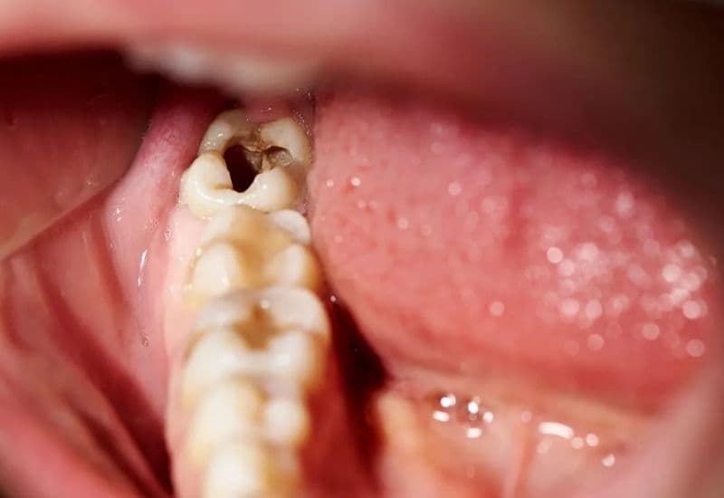 răng số 8 bị sâu có nên nhổ không