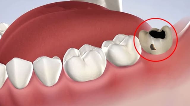 Răng số 8 bị sâu có nên nhổ không?
