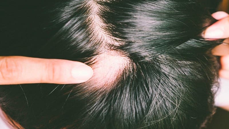 rụng tóc nhiều là dấu hiệu bệnh gì