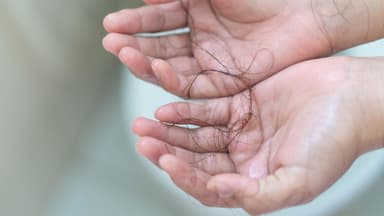 Rụng tóc nhiều là dấu hiệu bệnh gì?