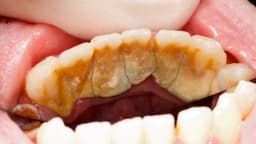 Sau khi lấy cao răng bao lâu thì được ăn?