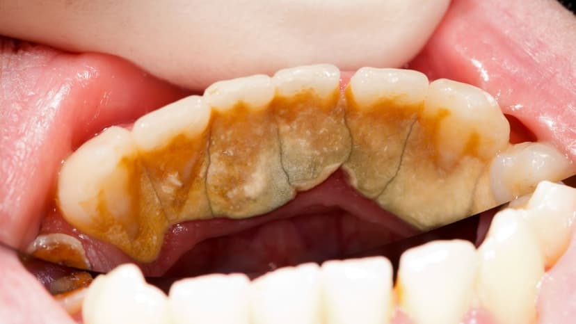 Sau khi lấy cao răng bao lâu thì được ăn?