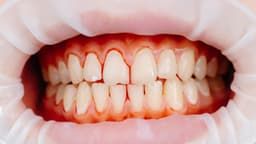 Sâu răng chảy máu có nguy hiểm?