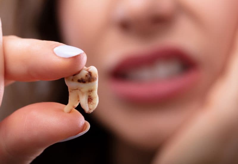 răng sâu độ 1 là như thế nào