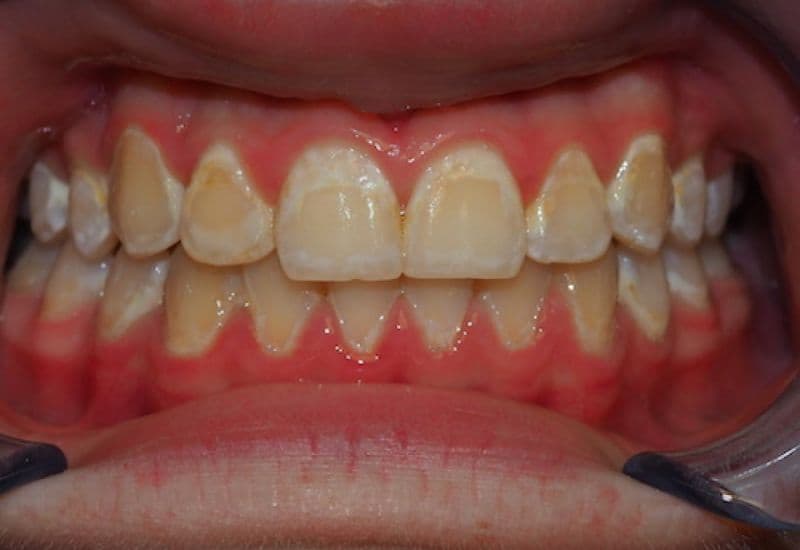 răng sâu độ 1 là như thế nào
