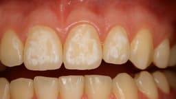 Răng sâu độ 1 là như thế nào?