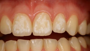 Răng sâu độ 1 là như thế nào?