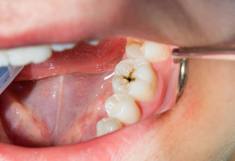 răng sâu độ 3 là như thế nào