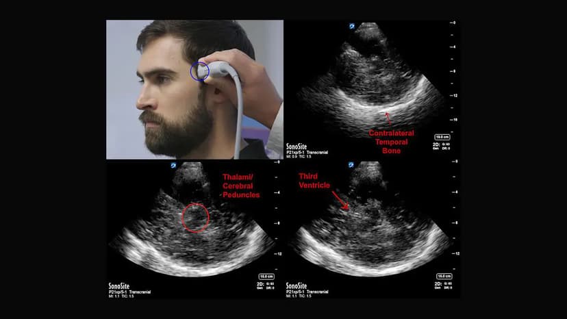 Siêu âm doppler xuyên sọ để làm gì?
