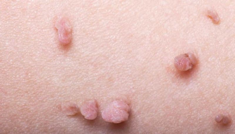Bác sĩ giỏi chữa sùi mào gà