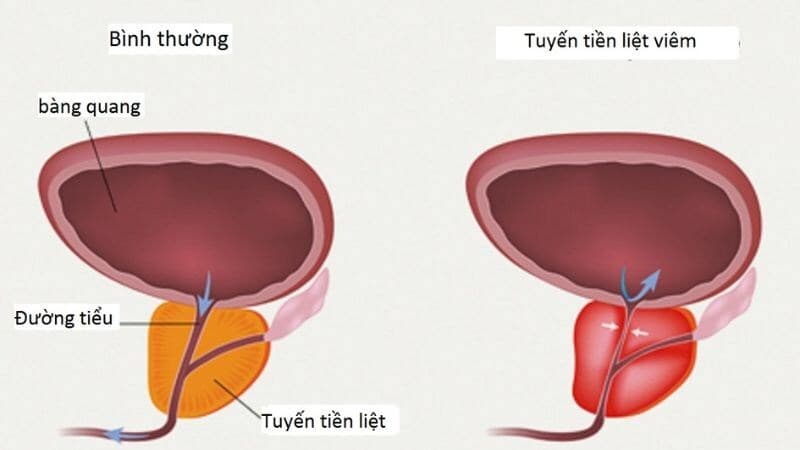 đau tinh hoàn sau khi cương