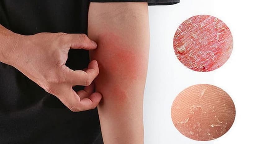 Vì sao suy thận ngứa da?