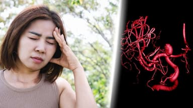 Phình mạch máu não có tái phát không?
