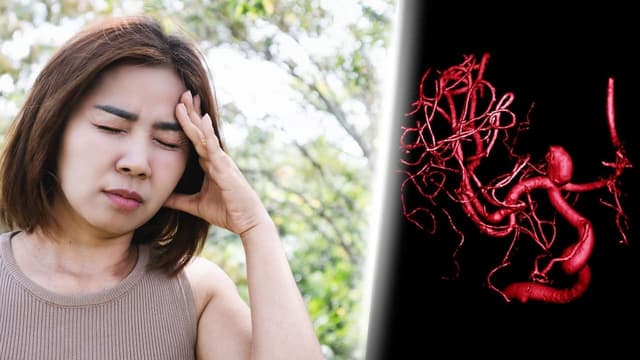 Phình mạch máu não có tái phát không?