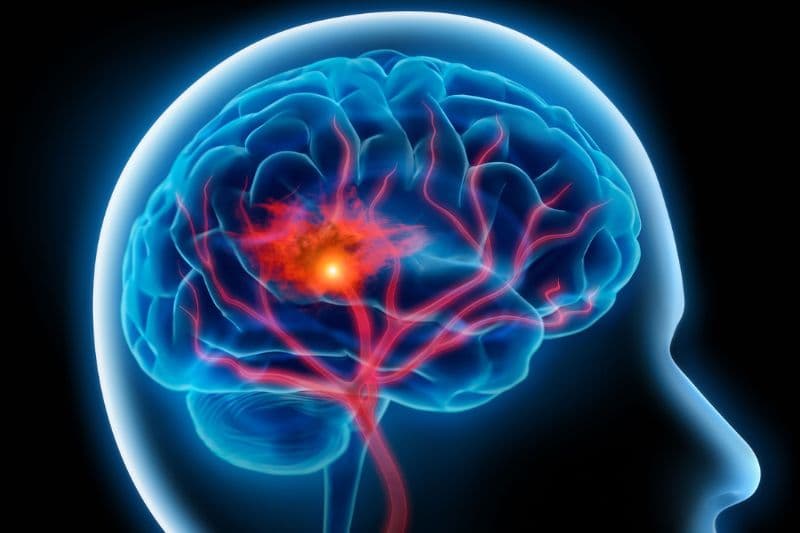 Ai cần tầm soát đột quỵ sớm? Giải đáp