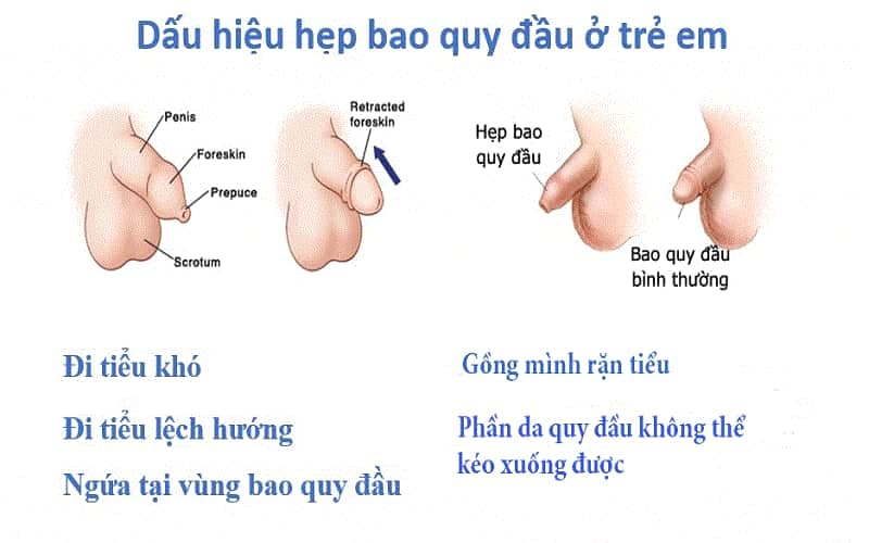 hẹp bao quy đầu