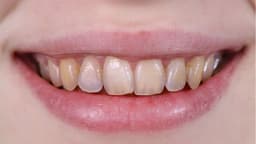 Thiểu sản men răng là bệnh gì?