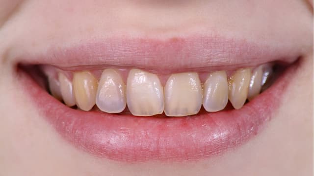 Thiểu sản men răng là bệnh gì?