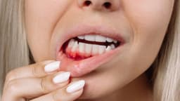 Mẹ bầu bị viêm lợi phải làm sao và cách xử lý an toàn, dứt điểm