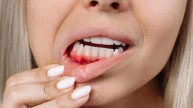 Mẹ bầu bị viêm lợi phải làm sao và cách xử lý an toàn, dứt điểm