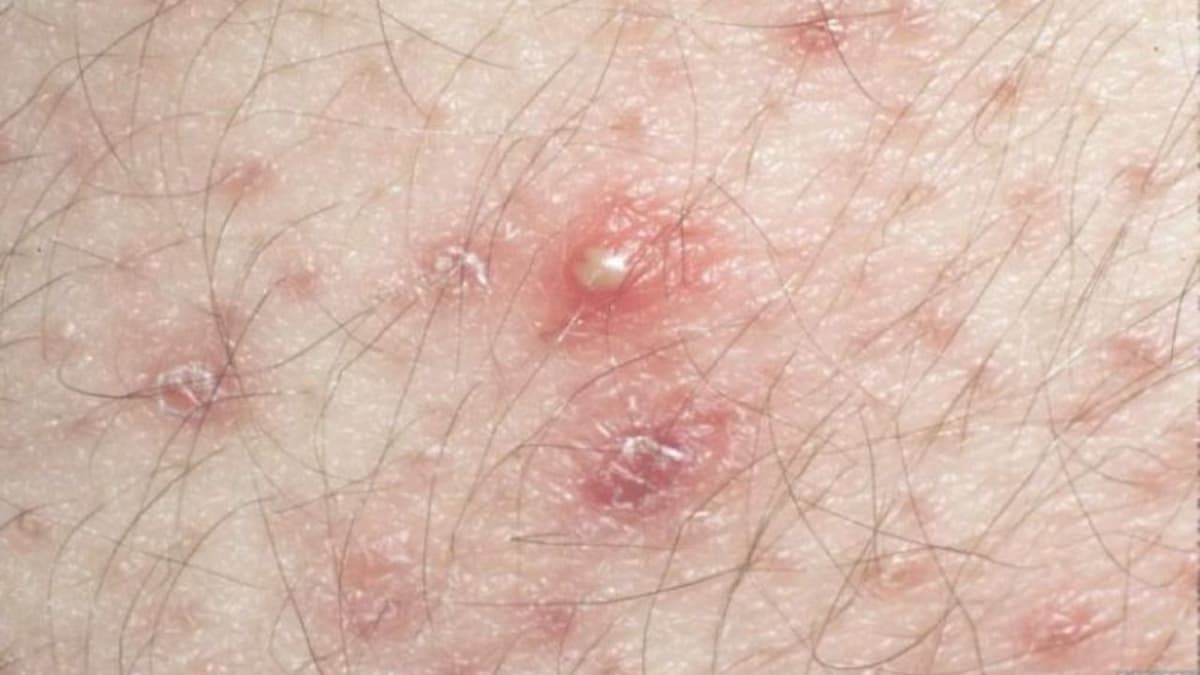 Giải đáp vấn đề bị viêm nang lông vùng kín bôi thuốc gì?