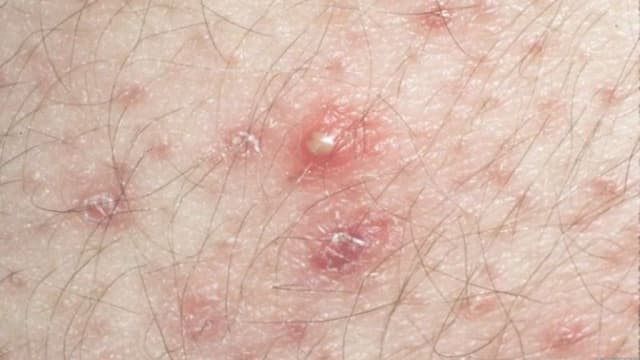 Giải đáp vấn đề bị viêm nang lông vùng kín bôi thuốc gì?