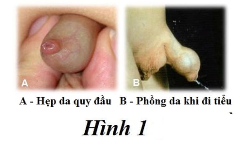 nguyên nhân hẹp bao quy đầu