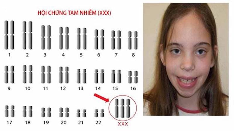 Hội chứng siêu nữ biểu hiện thế nào?