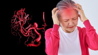 Dấu hiệu và nguyên nhân gây túi phình mạch máu não