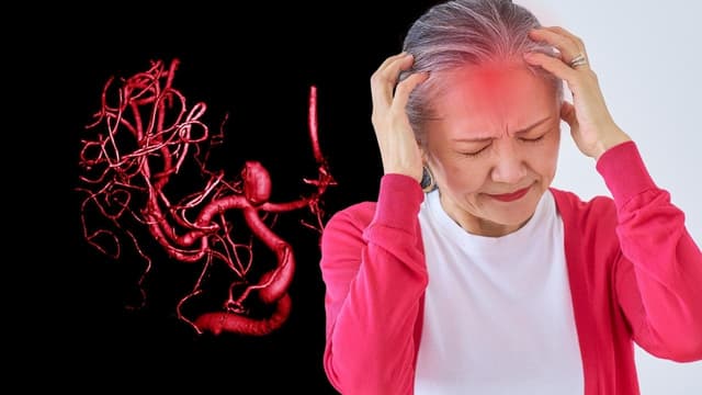 Dấu hiệu và nguyên nhân gây túi phình mạch máu não