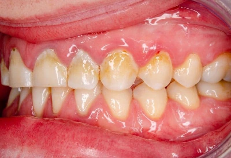vi khuẩn gây sâu răng sống ở đâu