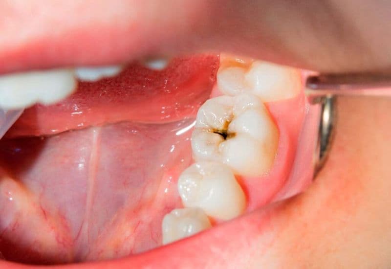 vi khuẩn gây sâu răng sống ở đâu