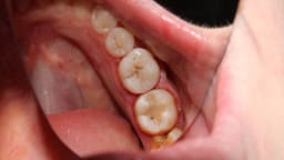 Vi khuẩn gây sâu răng sống ở đâu?