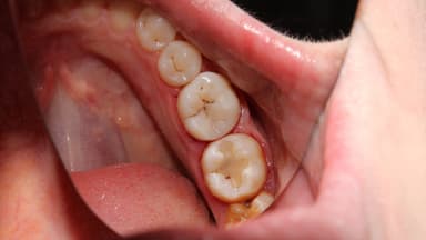 Vi khuẩn gây sâu răng sống ở đâu?