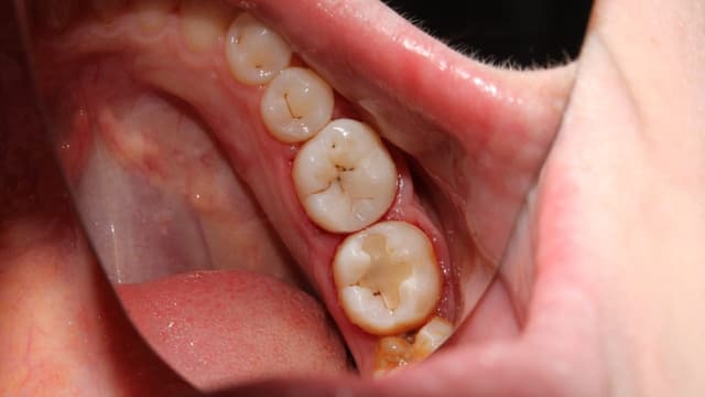 Vi khuẩn gây sâu răng sống ở đâu?