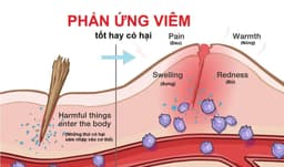 Giải đáp: Viêm có lợi hay có hại?