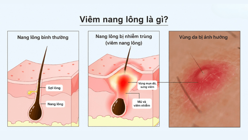 viêm nang lông vùng kín bao lâu thì khỏi