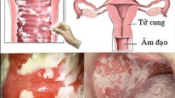 Viêm phụ khoa do nấm candida có chữa được không?